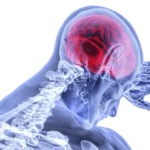 Centro de Neurorrehabilitación en Madrid